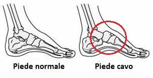 Hollow Foot Correction Insoles - Men's and Women's Shoes